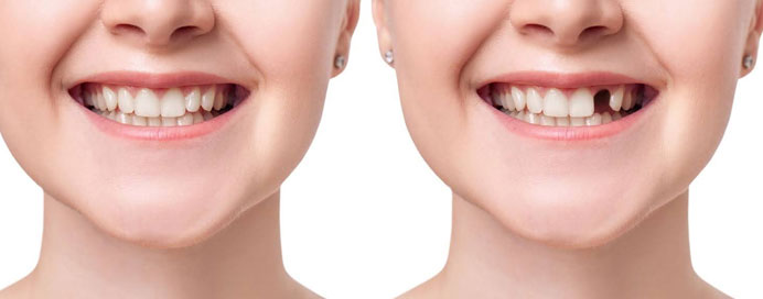 Replace Missing Teeth